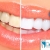 [Imagen:¡Paga Q395 en vez de Q1,500 por Blanqueamiento Dental Láser + Limpieza y Pulido Dental con Profilaxis + Eliminación de Sarro con Ultrasonido + Aplicación Tópica de Flúor + Examen Diagnóstico en Dental Life!]