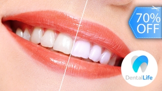 [Imagen:Blanqueamiento Dental con Luz LED, Limpieza, Pulido, Evaluación y Más.]