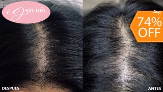 [Imagen:Sesión de Microblading Capilar en Área Frontal o Coronilla]