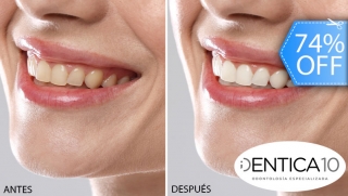 [Image: Blanqueamiento Dental Químico con Luz LED, Desmanchado con Profilaxis, Limpieza, Evaluación y Másm]