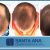 [Image: ¡Libérate YA de la Pérdida de Cabello! ¡Paga $200 en Lugar de $1,350 por 3 Sesiones de Plasma Rico en Plaquetas con Factores de Crecimiento para Alopecia (Calvicie)!m]