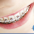 [Image: ¡Paga Q599 en Lugar de Q1,800 por Paquete de Ortodoncia que Incluye: Colocación de Brackets Metálicos (Superiores e Inferiores) + Evaluación y Diagnóstico Clínico + Limpieza Completa + Fotografías y Modelo de Estudio!m]