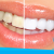 [Image: ¡Paga $75 en vez de $325 por 1 Sesión de Blanqueamiento Dental EXTREMO con sistema ZOOM + Limpieza con Ultrasonido!m]