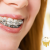 [Image: ¡Logra la Sonrisa que Siempre Soñaste! ¡Paga $90 en lugar de $550 por Colocación de Mini-Brackets Metálicos para Alineación de los Dientes + Evaluación y Diagnóstico Clínico + Fotografías y Modelo de Estudio!m]