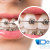 [Image: ¡Paga Q365 en lugar de Q2,500 por Colocación de Brackets (Superiores e Inferiores) + Limpieza Dental + Consulta Diagnóstica + Fotografías!m]