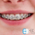 [Image: ¡Paga $75 en Lugar de $225 por Colocación de Mini-Brackets Metálicos + Evaluación y Diagnóstico Clínico + Fotografía y Modelos de Estudio!m]
