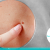 [Image: ¡Paga $20 en Lugar de $100 por Eliminación de hasta 20 Verrugas o Cabezas de Vena en Cuello, Axilas o Rostro + Consulta Dermatológica!m]