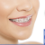 [Image: ¡Paga $75 en Lugar de $200 por Colocación de Mini-Brackets Metálicos + Evaluación y Diagnóstico Clínico + Fotografías y Modelo de Estudio!m]