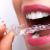 [Image: ¡Paga $18 en Lugar de $125 por Férula Dental + Evaluación Dental + Limpieza con Ultrasonido + Aplicación Tópica de Flúor!m]