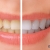 [Imagen:¡Paga $50 en Lugar de $250 por Blanqueamiento Dental Químico con Luz LED + Limpieza Profunda con Ultrasonido (Destartraje) + Consulta Odontológica!]