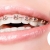 [Image: ¡Paga $90 en Lugar de $385 por Colocación de Brackets Metálicos + Evaluación y Diagnóstico Clínico + Fotografías y Modelo de Estudio + 3 Consultas de Control!m]