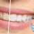 [Image: ¡Paga Q395 en lugar de Q1,800 por Blanqueamiento Dental Láser + Pulido Dental con Profijet + Limpieza con Ultrasonido + Aplicación de Flúor y Evaluación con Cámara Intraoral!m]