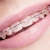 [Image: ¡Paga Q1,400 en lugar de Q4,500 por Colocación de Mini-Brackets INVISIBLES (Superiores e Inferiores) + Evaluación y Diagnóstico Clínico + Profilaxis Dental + Fotografías y Modelo de Estudio!m]