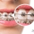 [Image: ¡Paga $90 en Lugar de $385 por Colocación de Brackets Metálicos + Evaluación y Diagnóstico Clínico + Fotografías y Modelo de Estudio + 3 Consultas de Control!m]