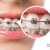 [Image: ¡Paga $90 en Lugar de $385 por Colocación de Brackets Metálicos + Evaluación y Diagnóstico Clínico + Fotografías y Modelo de Estudio + 3 Consultas de Control!m]