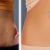 [Image: ¡Paga Q375 en Lugar de Q750 por Camuflaje de Estrías (Maquillaje Permanente) en Área a Elección entre Glúteos, Brazos o Abdomen!m]