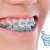[Image: ¡Paga Q499 en Lugar de Q3,000 por Colocación de Mini-Brackets Metálicos (Superiores e Inferiores) + Evaluación y Diagnóstico Clínico + Profilaxis Dental + Fotografías + Kit de Limpieza Completo!m]