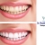 [Image: ¡Paga $85 en lugar de $325 por 1 Sesión de Blanqueamiento Dental con Sistema Zoom + Consulta Odontológica + Diagnóstico con Cámara Intraoral + Limpieza con Ultrasonido en Western Dental!m]