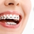 [Imagen:¡Paga Q299 en Lugar de Q1,800 por Colocación de Brackets Metálicos (Superiores e Inferiores) + Evaluación y Diagnóstico Clínico + Profilaxis Dental + Fotografías Dentales!]