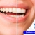 [Image: ¡Paga $50 en Lugar de $250 por Blanqueamiento Dental Químico con Luz LED + Baño de Gel Desensibilizante + Limpieza Profunda con Ultrasonido (Destartraje) + Consulta Odontológica!m]