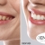 [Image: ¡Paga Q395 en Lugar de Q1,520 por Blanqueamiento Dental Químico con Luz LED + Desmanchado con Profilaxis + Limpieza con Ultrasonido + Evaluación Completa!m]