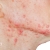 [Image: ¡Paga Q499 en Lugar de Q2,500 por Tratamiento VIP Antiacné con: Dermapen + Microdermoabrasión + Cauterización + Mascarilla Purificante + Oxigenación + Limpieza!m]