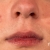 [Image: ¡Paga Q499 en Lugar de Q2,500 por Tratamiento VIP Antiacné con: Dermapen + Microdermoabrasión + Cauterización + Mascarilla Purificante + Oxigenación + Limpieza!m]
