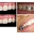 [Image: ¡Paga $25 en Lugar de $210 por Reconstrucción Mínimamente Invasiva de 4 Dientes Frontales + Consulta General + Limpieza Dental + Aplicación Tópica de Flúor + Férula + Estuche!m]