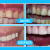 [Image: ¡Logra una sonrisa perfecta! Paga $25 en lugar de $125 por Diseño de Sonrisa con: Carilla Dental de Resina Nano Híbrida de Porcelana y Zirconio!m]