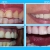 [Image: ¡Recupera Tu Sonrisa Perfecta! ¡Paga $30 en Vez de $125 por Paquete a Elección de Carillas Dentales de Resina Nano Híbrida de Porcelana y Zirconio Entre: A) 1 Carilla + Limpieza + Férula + Estuche, B) 2 Carillas + Limpieza o C) 4 Carillas!m]