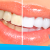 [Image: ¡Paga $79 en vez de $325 por 1 Sesión de Blanqueamiento Dental EXTREMO con sistema ZOOM + Limpieza con Ultrasonido en la Lujosa Sala VIP de Western Dental San Benito!m]