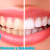 [Image: ¡Paga $70 en lugar de $237 por Blanqueamiento Dental con Sistema Zoom + Limpieza con Ultrasonido + Diagnóstico con Cámara Intraoral + Revisión de Cordales en Clínica Médica Romano y Asociados!m]
