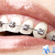 [Image: ¡Paga $85 en lugar de $450 por Colocación de Mini-Brackets Metálicos + Evaluación y Diagnóstico de Ortodoncia + Diagnóstico Odontológico General + Profilaxis Dental!m]