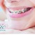 [Imagen:¡Paga Q599 en lugar de Q1,800 por Paquete de Ortodoncia con: Colocación de Brackets Metálicos (Superiores e Inferiores) + Evaluación y Diagnóstico Clínico + Profilaxis Dental + Fotografías y Modelo de Estudio!]