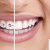 [Imagen:¡Paga $95 en Lugar de $575 por Colocación de Brackets Metálicos para Alineación de Dientes!]