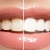 [Imagen:¡Paga $50 en Lugar de $200 por Blanqueamiento Dental Químico con Luz LED + Limpieza Profunda con Ultrasonido (Destartraje) + Consulta Odontológica!]