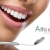 [Imagen:¡Paga $65 en Lugar de $190 por Blanqueamiento Dental con Luz LED!]