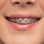 [Imagen:¡Paga $40 en Lugar de $110 por Colocación de Brackets Metálicos + Evaluación y Diagnóstico Clínico + Rayos X + 1 Consulta de Control + 1 Limpieza Dental!]