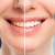[Imagen:¡Paga Q395 en Lugar de Q1,500 por Blanqueamiento con Luz LED + Pulido Dental + Plan de Tratamiento + Evaluación con Cámara Intraoral!]