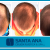 [Imagen:¡Libérate YA de la pérdida de cabello! ¡Paga $200 en vez de $1350 por 3 Sesiones de Plasma Rico en Plaquetas para Alopecia con Factores de Crecimiento en Santa Ana Cirugía Plástica y Spa!]