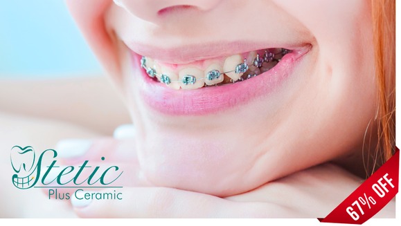 [Image: ¡Paga Q599 en lugar de Q1,800 por Paquete de Ortodoncia con: Colocación de Brackets Metálicos (Superiores e Inferiores) + Evaluación y Diagnóstico Clínico + Profilaxis Dental + Fotografías y Modelo de Estudio!m]