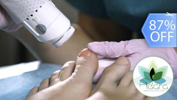 [Image: ¡Paga Q399 en lugar de Q3,100 por Sesión Láser para Eliminar Hongos en 10 Uñas de los Pies!m]