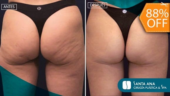 [Image: ¡Paga $200 en Lugar de $1,610 por Tratamiento Intensivo para Eliminación de Celulitis y Flacidez y Reducción de Medidas de los Glúteos y Muslos con 2 Sesiones de Plasma Rico en Plaquetas, 5 PRCell y 1 Sesión de Radiofrecuencia!m]