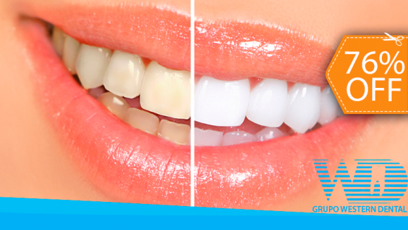 [Image: ¡Paga $79 en vez de $325 por 1 Sesión de Blanqueamiento Dental EXTREMO con sistema ZOOM + Limpieza con Ultrasonido!m]
