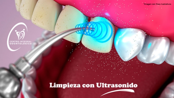 [Image: ¡Paga Q85 en lugar de Q500 por Limpieza Dental con Ultrasonido + Pulido Dental con Profijet + Aplicación de Flúor + Examen de Diagnóstico con Radiografías Digitales!m]