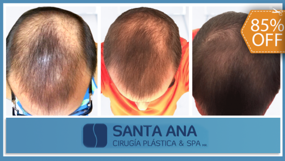 [Image: ¡Libérate YA de la Pérdida de Cabello! ¡Paga $200 en Lugar de $1,350 por 3 Sesiones de Plasma Rico en Plaquetas con Factores de Crecimiento para Alopecia (Calvicie)!m]