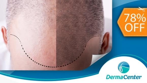 [Image: ¡Libérate de la Calvicie! ¡Paga $199 en vez de $900 por 3 Sesiones de Plasma Rico en Plaquetas para Alopecia (Calvicie)!m]