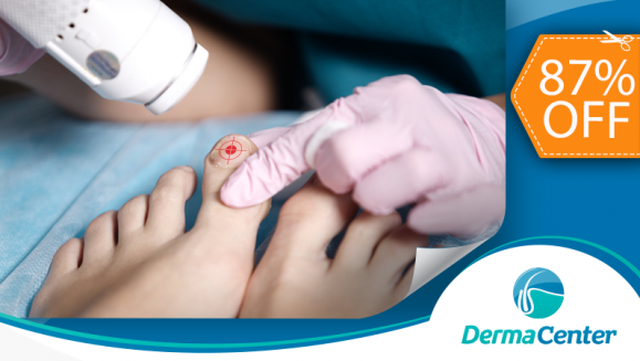 [Image: ¡Paga $39 en lugar de $300 por Tratamiento Láser para 2 Uñas con Hongos + Evaluación Previa con Dermatólogo!m]