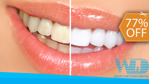 [Image: ¡Paga $75 en vez de $325 por 1 Sesión de Blanqueamiento Dental EXTREMO con sistema ZOOM + Limpieza con Ultrasonido!m]