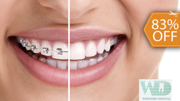 [Image: ¡Paga $95 en Lugar de $575 por Colocación de Brackets Metálicos para Alineación de Dientes!m]